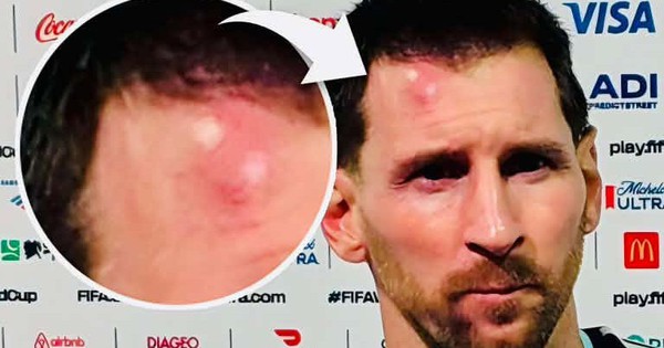 Messi sưng vêu trán sau trận thắng Cabo Verde: Vì sao nên nỗi? - hình ảnh - betokfun.vip Messi sưng vêu trán sau trận thắng Cabo Verde: Vì sao nên nỗi? - hình ảnh - betokfun.vip